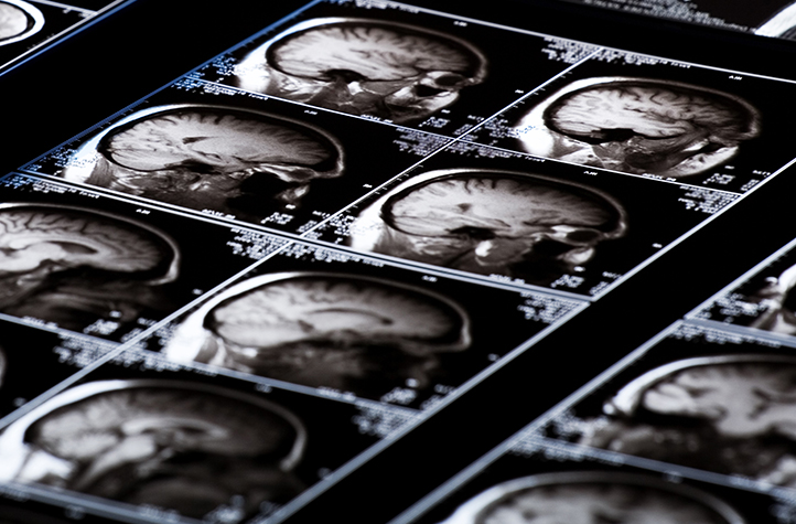 Kachel_Alzheimer Röntgen bei der Radiologie Hessen